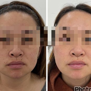 The Space Aesthetics - Skin looking better only after 2 M22 treatments - Medical Spas Near Me - San Mateo, California The Space Aesthetics - Skin looking better only after 2 M22 treatments - Medical Spas Near Me - San Mateo, California