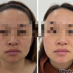 The Space Aesthetics - Skin looking better only after 2 M22 treatments