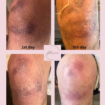 Glowrious Skin - The power of VI Peel - Skin Care Near Me - Thousand Oaks, California Glowrious Skin - The power of VI Peel - Skin Care Near Me - Thousand Oaks, California
