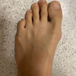 John DelMonte, DPM - Del Monte Podiatry - Left foot before surgery
