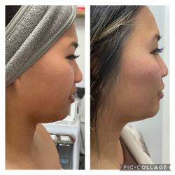 Pretty little faces Body Bar - Radio frequency tightening treatment