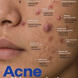 Skin Deep By Christine - Acne is not one condition with one treatment. Choosing the right one can make a significant difference. Trust the experts!