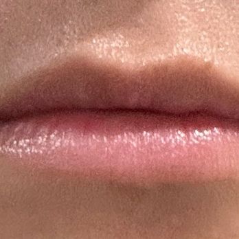 Dermaster - before - Skin Care Near Me - Los Angeles, California