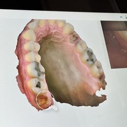 Miracle Smile Dentistry - El Segundo - 3D scanned images of the teeth