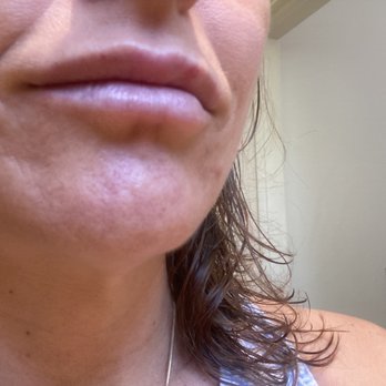 Renee Patel, MD - Next day, showing zero bruising, thanks to her special techniques.  (Photo Without makeup.) - Laser Hair Removal Near Me - Downey, California