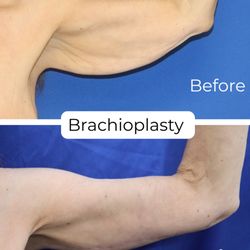 Brett Stompro, MD & Chester Cheng, MD - Brachioplasty