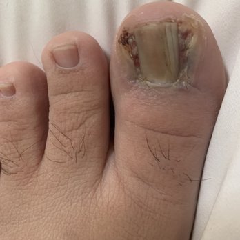 Tower Podiatry - Toe nail - Podiatrists Near Me - Los Angeles, California