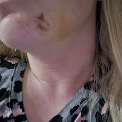 American Dental Solutions - Swelling and bruising