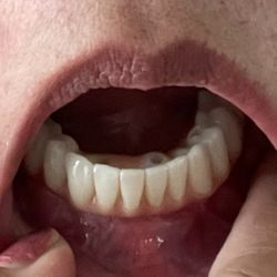 Denture not align with my gum line, sticking out. Inside you can see where the abutment and penetrating outward which is unsightly.