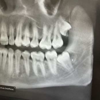 Lake Wylie Modern Dentistry - Wisdom teeth - General Dentistry Near Me - Clover, South Carolina Lake Wylie Modern Dentistry - Wisdom teeth - General Dentistry Near Me - Clover, South Carolina