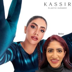 Ramtin Kassir, MD - Noor Stars after Designer Rhinoplasty®