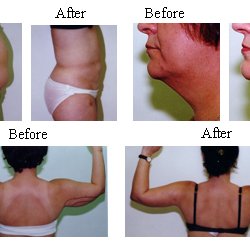 Aesthetic Medical Center - Local anesthetic: Liposuction/body-sculpture