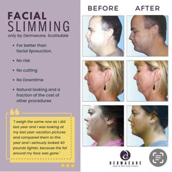 Dermacare Non-Surgical Face & Body Sculpting - Our facial slimming procedure will make you look much lighter without losing an ounce! This is a separate protocol from the "smart Lift"