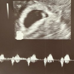 Center For Reproductive Endocrinology - 7 weeks and we heard our baby's heartbeat!