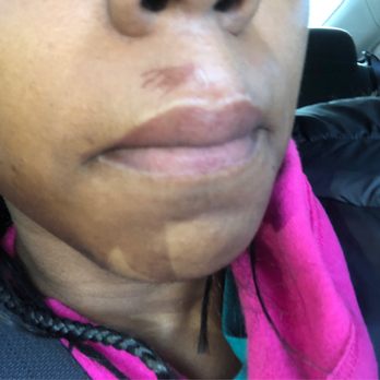 Pink Nails & Spa - Upper lip after terrible wax experience - Nail Salons Near Me - Philadelphia, Pennsylvania Pink Nails & Spa - Upper lip after terrible wax experience - Nail Salons Near Me - Philadelphia, Pennsylvania