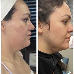 Natural Rejuvenation MedSpa - Facetite and Morpheus8