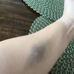 ProSource Hydration - Blown-out vein
