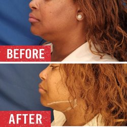 Chin contouring treatment before and after.