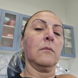 My burned face.
