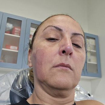 Dental Studio of Pasadena - My burned face. - General Dentistry Near Me - Pasadena, California