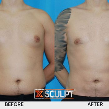 XSculpt - Chest liposuction with breast gland removal & hi-definition liposuction of abdomen, flanks and back. 2mos post op - Cosmetic Surgeons Near Me - Chicago, Illinois