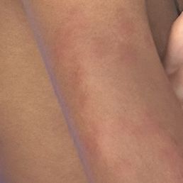 Bed bug bites Bed bug bites
