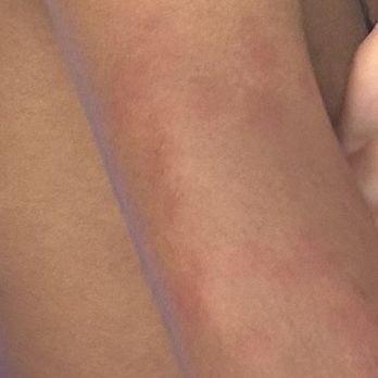 The Morgan - Bed bug bites - Hotels Near Me - San Simeon, California