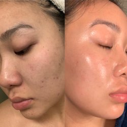 Skin by Janny - Before/after. Last treatment was nanoneedling. Skin treatment curated by Janny.