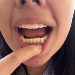 Nolan Smiles Orthodontics - Before braces
