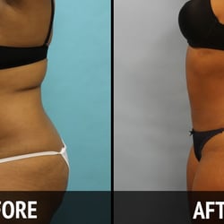 Indian Wells Med Spa - Abdominal smartlipo patient