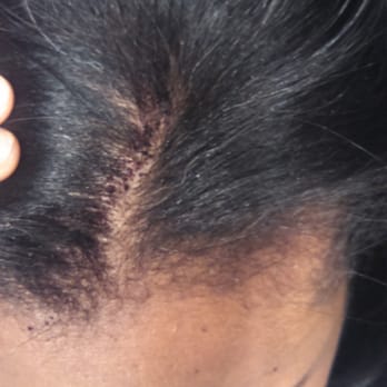 Drybar - Georgetown - Burnt scalp and i have a huge chunk of hair burnt off. - Blow Dry/Out Services Near Me - Washington, DC, District of Columbia
