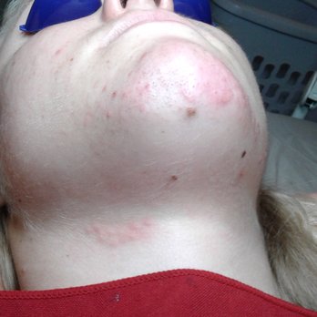 Dragonfly Facials - after electrolysis redness fades quickly - Skin Care Near Me - Sierra Vista, Arizona