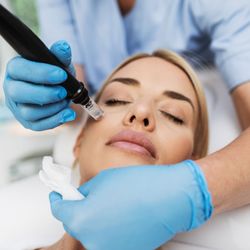 Elite Laser - Microneedling offered