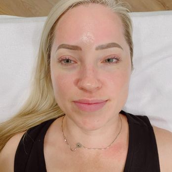 Eleyyc - Chemical Peels - Hair Removal Near Me - Calgary, Alberta