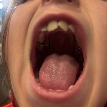 Lawrence J. Levens, DDS, MsD, MScLO - Put a spacer in her mouth. It corrected her underbite and straightened her teeth a bit so we can wait to get braces. - Orthodontists Near Me - Saint Louis, Missouri Lawrence J. Levens, DDS, MsD, MScLO - Put a spacer in her mouth. It corrected her underbite and straightened her teeth a bit so we can wait to get braces. - Orthodontists Near Me - Saint Louis, Missouri