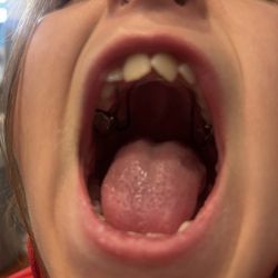 Lawrence J. Levens, DDS, MsD, MScLO - Put a spacer in her mouth.  It corrected her underbite and straightened her teeth a bit so we can wait to get braces.