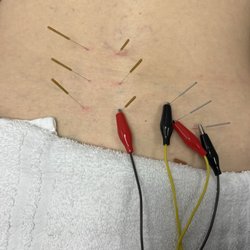 Tier 1 Direct Physical Therapy - Electrical dry needling for lower back pain. (Taken with permission)