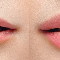 Botox, Fillers & More