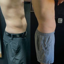 OC Body Clinic - 6 sessions of body sculpting results