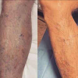 iThriveVeins