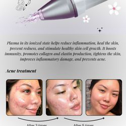 PMU Clinic - acne treatment