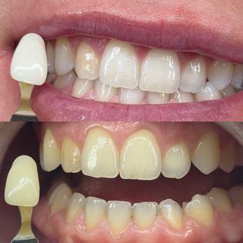 The Coco Blanc Teeth Whitening - Before & After - Teeth Whitening Near Me - Whittier, California The Coco Blanc Teeth Whitening - Before & After - Teeth Whitening Near Me - Whittier, California