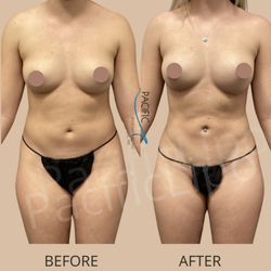 Pacific Lipo - San Diego - Upper & lower abdomen with love handles lipo under local anesthesia (while patient fully awake).