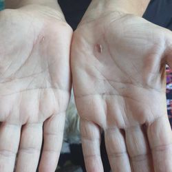 Carpal Tunnel Express - 2 weeks post op.  Hardly any scars at all !