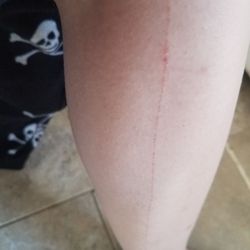 H&M - From knee to almost ankle cut from big round store tac that was in the right pants pocket of the pants I tried on