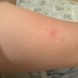 Z Relax On Union - Skin reaction post massage