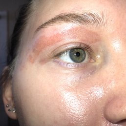 Burnt off skin - very painful Burnt off skin - very painful