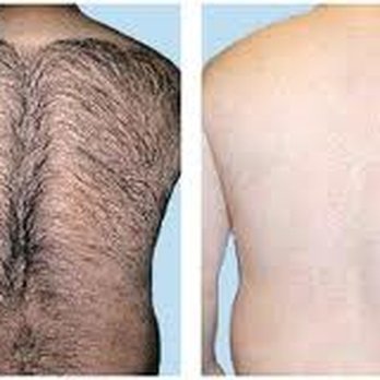 Beauty Spa Soho - laser hair removal before and after - Laser Hair Removal Near Me - New York, New York Beauty Spa Soho - laser hair removal before and after - Laser Hair Removal Near Me - New York, New York