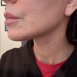 Rich J Smythe, MD - 2 weeks after deep plan face lift with Dr. Rich