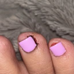 Cuts on my toes Cuts on my toes